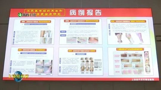 干細胞治療創(chuàng)面修復(fù)