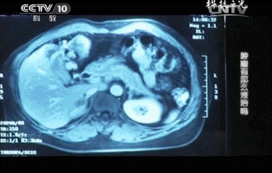 存儲免疫細胞有用嗎? 存儲免疫細胞有用嗎?