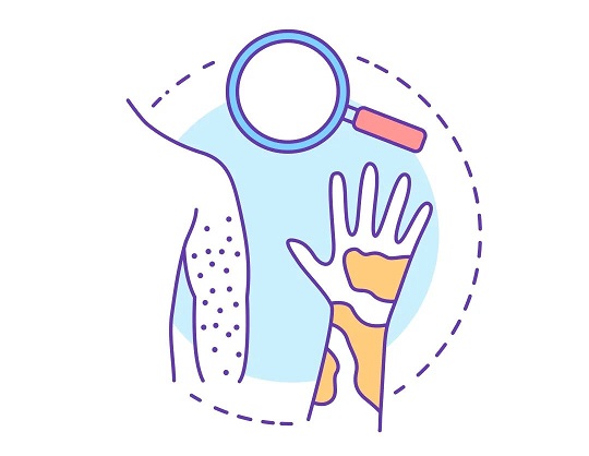 免疫細(xì)胞治療濕疹 免疫細(xì)胞治療濕疹